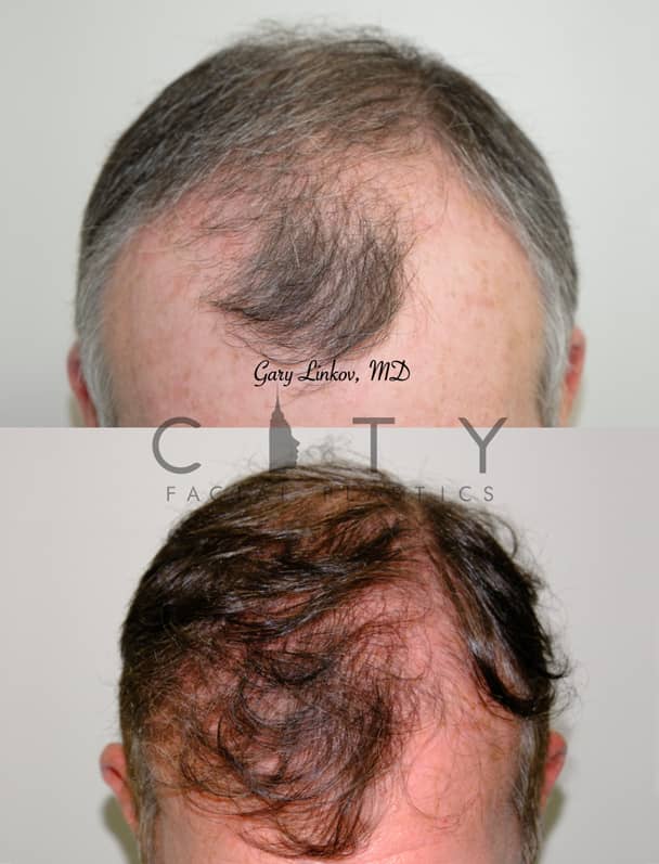 NYC Hair Transplant Before and After Pictures New York UES