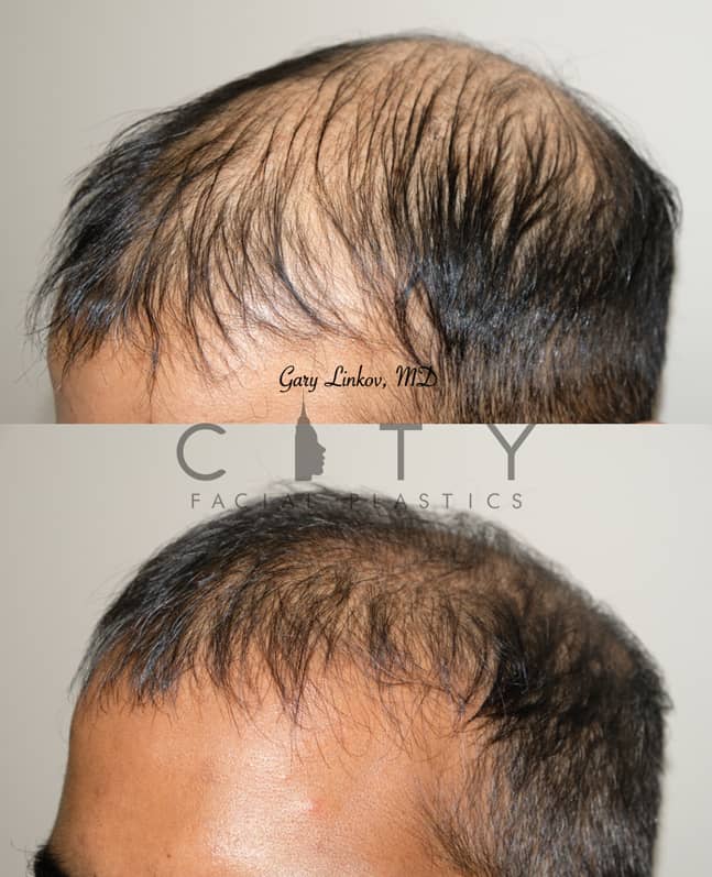 NYC Hair Transplant | New York Hair Restoration Clinic For Men, Women