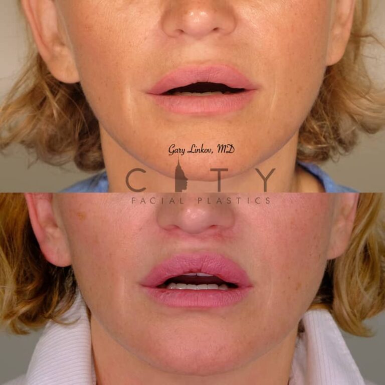 Lip Lift Before and After | New York Plastic Surgeon Dr. Linkov