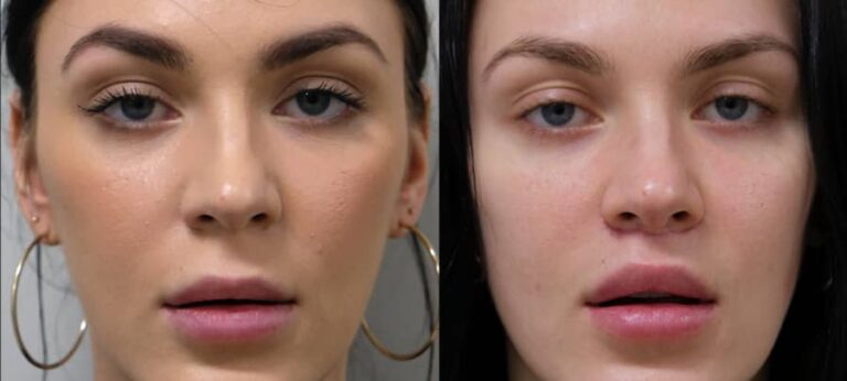 Lip Lift In New York City | Upper Lip Lift Surgery Manhattan