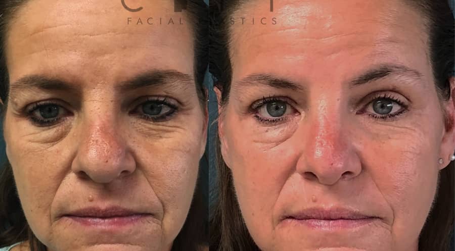 Rhinoplasty New York City Best Manhattan Nose Job