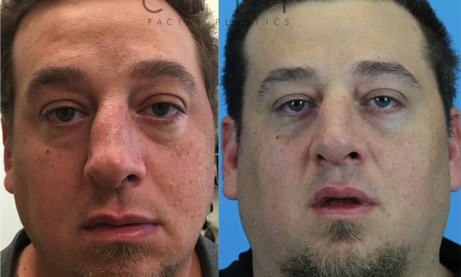 Rhinoplasty New York City Best Manhattan Nose Job