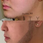 Hair Transplant 14 Left