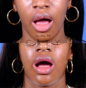 Lip Reduction 4 frontal mouth open