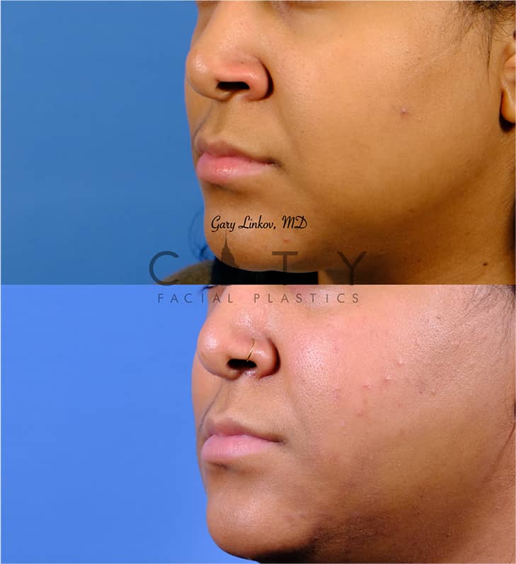NYC Nostril Reduction Before and After Pictures | New York | UES