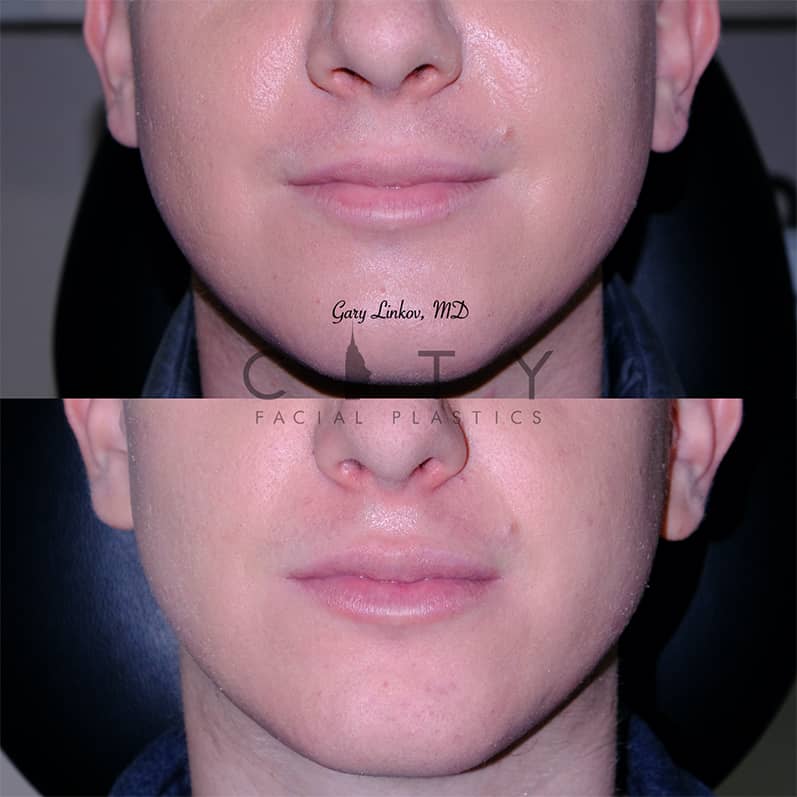 Botox and Filler Before and After New York