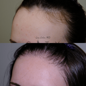 Hair-transplant_26_case_6_L-oblique