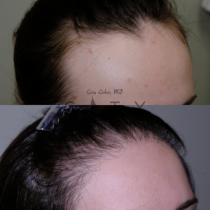 Hair Restoration Option | Advanced Hairline Restoration