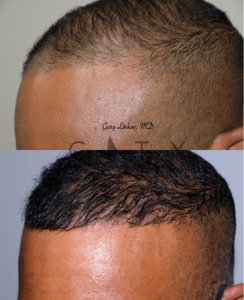 Hair transplant_8_case_5_left