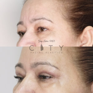 Bleph 1 case 3 Oblique