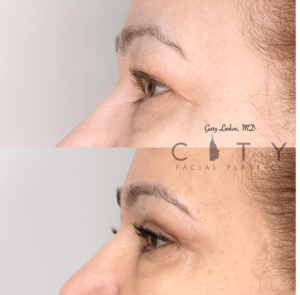 Bleph 1 case 3 Profile