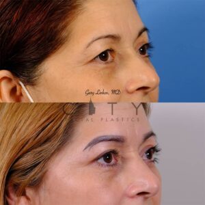 Bleph-2-case-2-Right-oblique