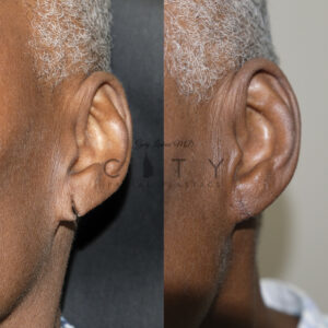 Ear lobe repair 2 case 4 Oblique