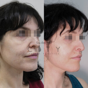 Facelift 1 case 3 oblique