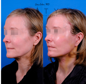 Facelift 5_case 2 L oblique