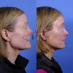 Facelift 5_case 2 profile