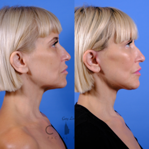 Facelift 7_case_1_R profile