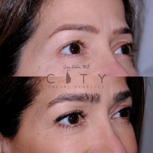 Hair-transplant_19_case_3_R-oblique