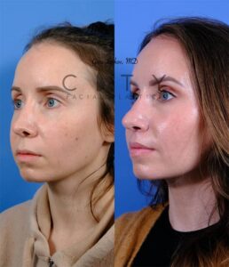 Lip-lift-52-case-7-L-oblique-mouth-closed