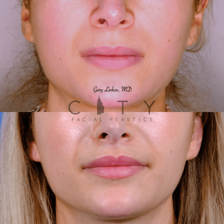 NYC Bullhorn Lip Lift Surgery | New York Subnasal Lip Enhancement