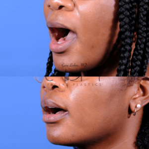 3 months after elelyft ethnic lip lift to reduce the philtrum, without distorting natural lip aesthetics