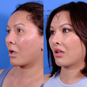 Side view, 5 months after an elelyft lip lift in NYC