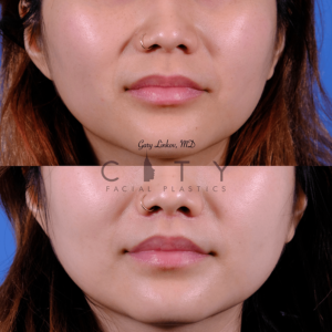 Front view, 3 months post reshaping and tweaking lip in NYC by Dr. Gary Linkov
