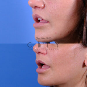 Side view, 3 months post frontal lip lift in NYC