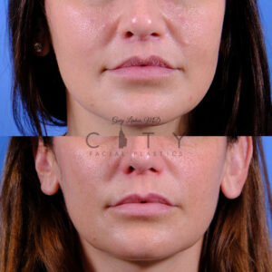 Front view, 3 months post frontal lip lift in NYC
