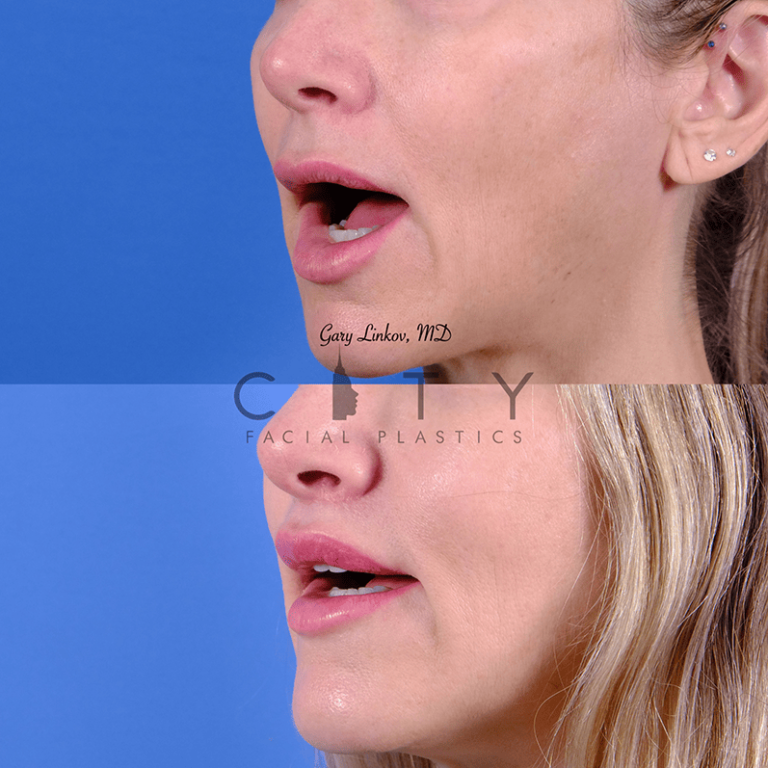 NYC Bullhorn Lip Lift Surgery | New York Subnasal Lip Enhancement