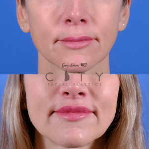 3 months post elelyft lip lift in NYC