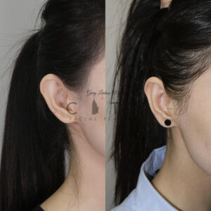 Otoplasty 1 case 3 oblique