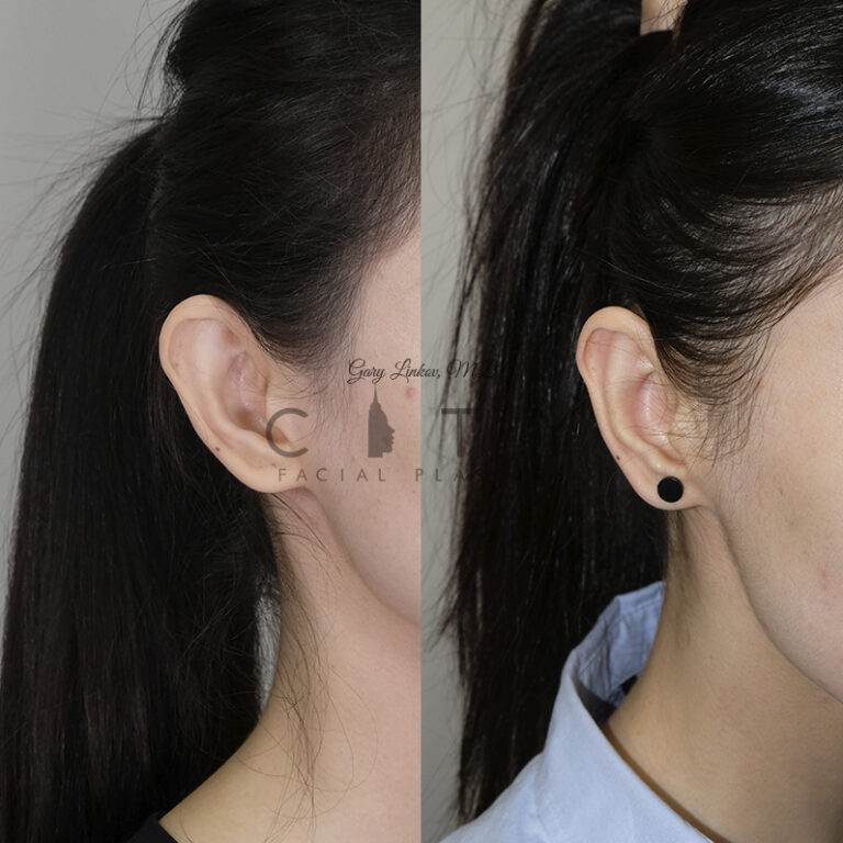 Otoplasty Near Me Improves Self-Esteem and Confidence