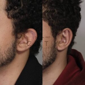 Otoplasty 2 case 2 oblique