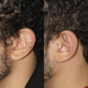 Otoplasty 2 case 2 profile