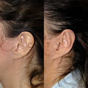Otoplasty 3 case 1 profile