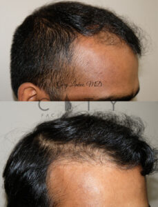 hair-transplant-6-case_4_right