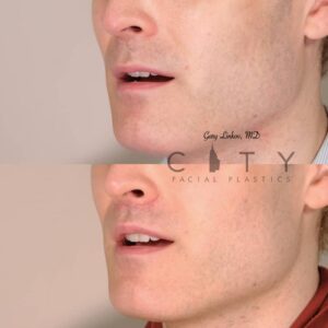 lip-lift-34-case-3-L-oblique-mouth-open