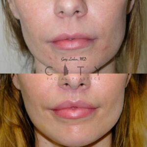 lip-lift-36-case-4-frontal-mouth-closed