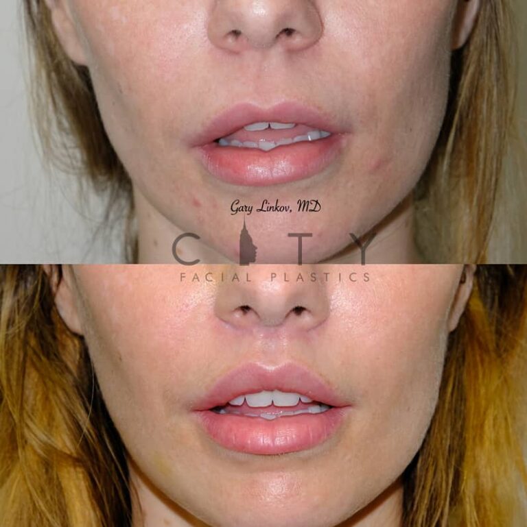 NYC Bullhorn Lip Lift Surgery | New York Subnasal Lip Enhancement