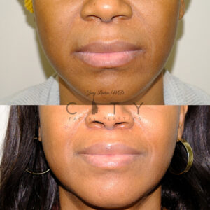 lip-lift-41-case-6-frontal-mouth-closed