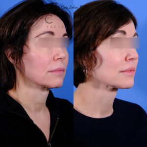 Patient Result oblique closed case 3