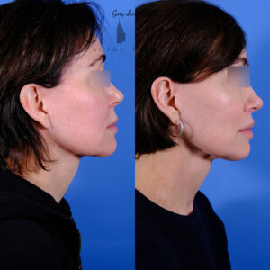 Patient Result profile case 3