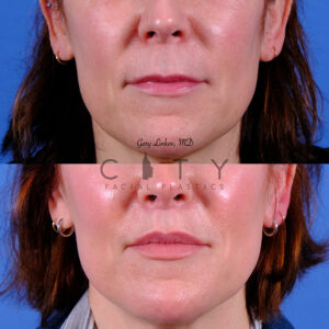 Lip lift 86 frontal mouth closed case 14