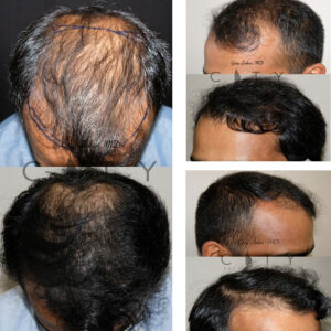 Hair Transplant NYC | Hair Restoration Manhattan, New York