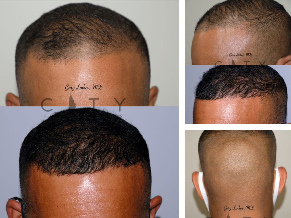 Hair Transplant Nyc Hair Restoration Manhattan New York