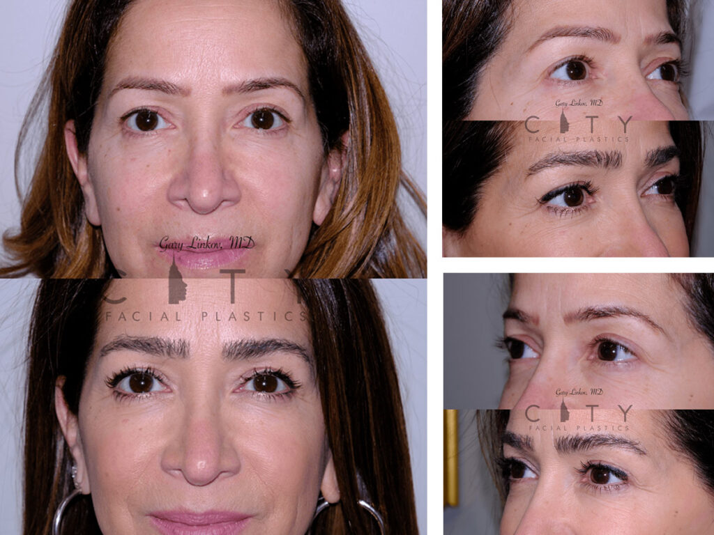 Hair Transplant NYC Hair Restoration Manhattan, New York