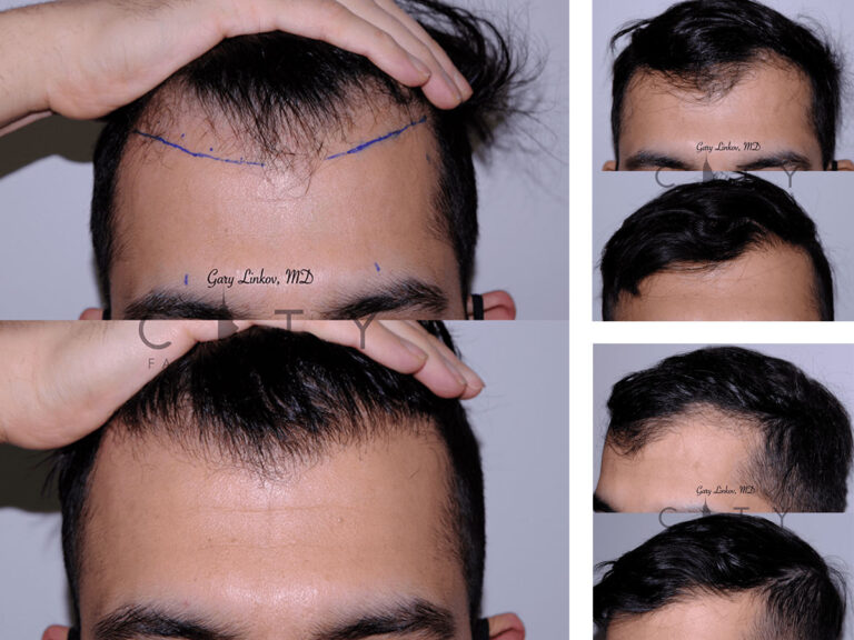 Hair Transplant NYC Hair Restoration Manhattan, New York