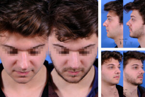 Best Rhinoplasty NYC