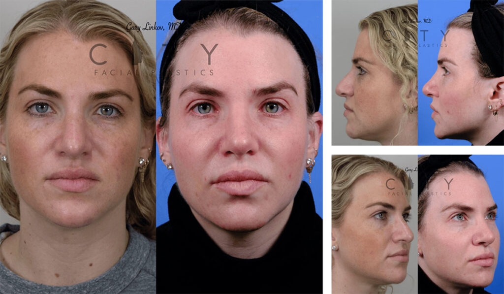 Rhinoplasty NYC | Best Nose Job Surgeon New York City - Dr. Linkov